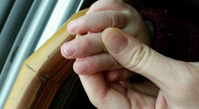 孩子手上长倒刺怎么办？如何做预防?