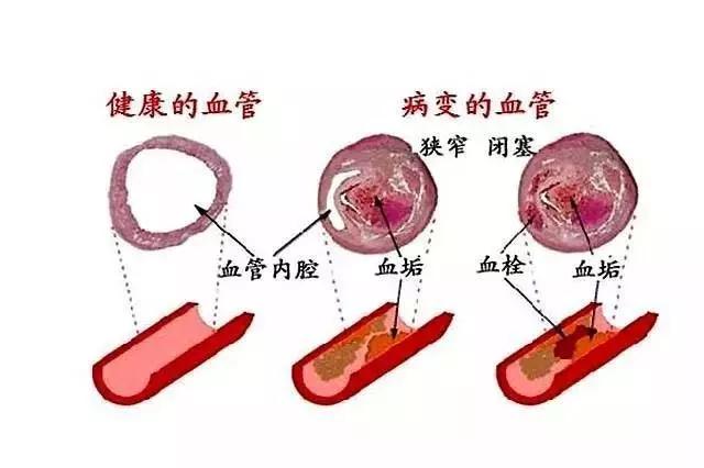 血栓死亡率远超肿瘤!(图6) 血栓死亡率远超肿瘤!(图6)