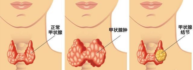 甲状腺结节会不会发展为甲状腺癌？结节要不要做手术？(图1)