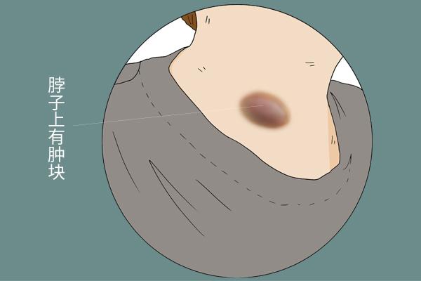 身体若出现3种“疙瘩”,可能癌细胞来报道(图2) 身体若出现3种“疙瘩”,可能癌细胞来报道(图2)