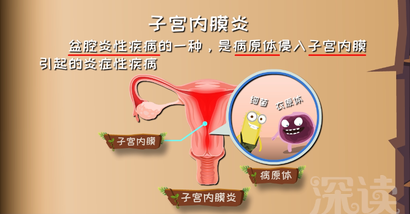 15%的小姐姐都会遭遇子宫内膜炎?还有啥症状?(图2) 15%的小姐姐都会遭遇子宫内膜炎?还有啥症状?(图2)